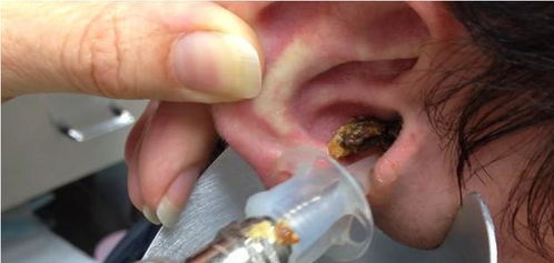 1 "耳屎"也有人称为"耳蝉",医学名称叫"外耳道耵聍".