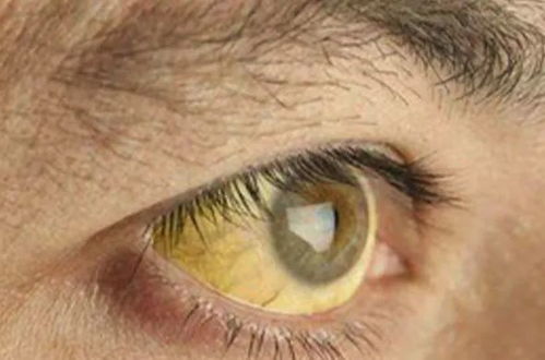 巩膜发黄的图片巩膜发黄是怎么回事