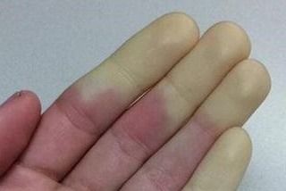白血病的手指甲图图片