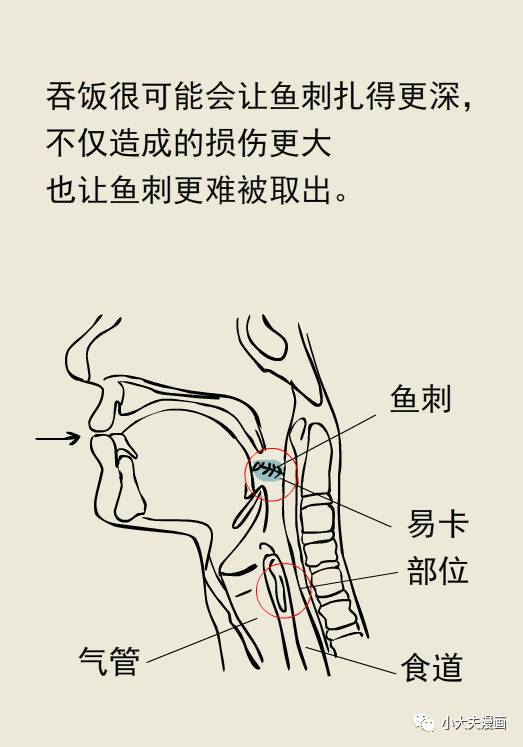 喉咙卡鱼刺了怎么办