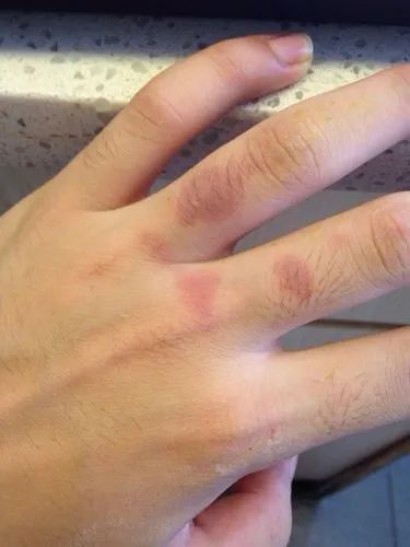 一度烫伤疤痕图片