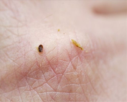 婴儿脸上被螨虫咬的症状图片