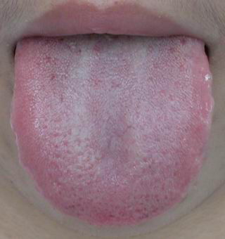 慢性舌叶状乳头炎症状图片