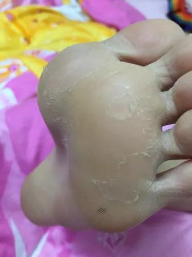 小孩脚底脱皮图片 怎么回事