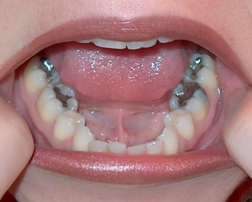 刚补完牙可以刷牙吗