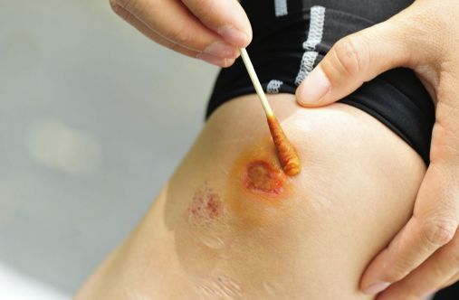 愈合伤口吃什么食物好得快,恢复刀口吃什么好得快