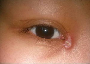 开眼角后疤痕增生图片什么时候消