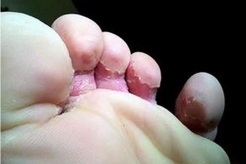 得了脚气该怎么办