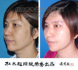 微创面部提升除皱术