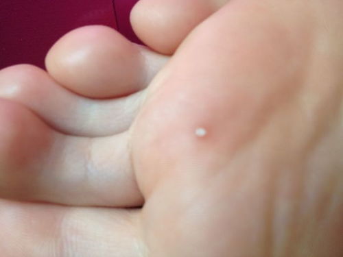 脚上的鸡眼怎么根治有几种治法