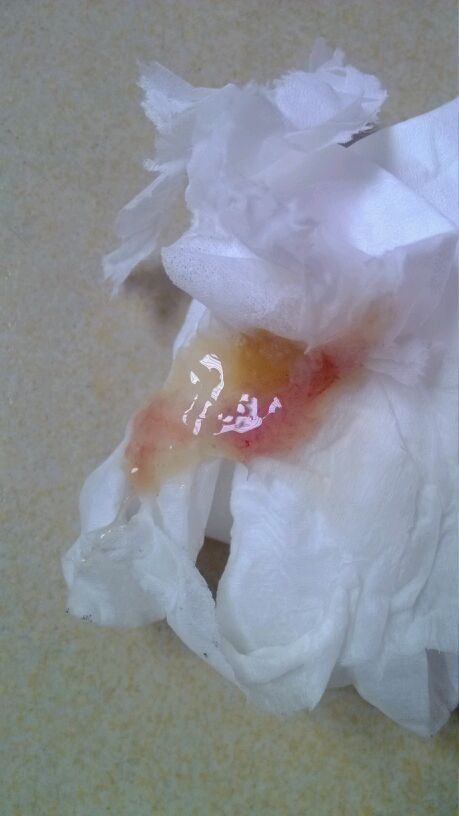 如果是排便后出血,而且是血,而且是分离的不混大便,一般考虑是直肠或