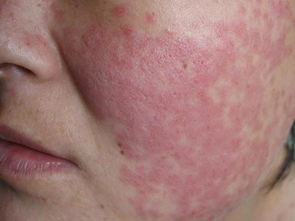 红班狠疮疤症状图片