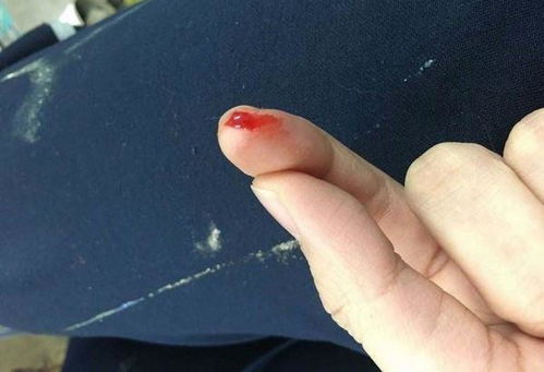 手被仓鼠咬出血有事吗