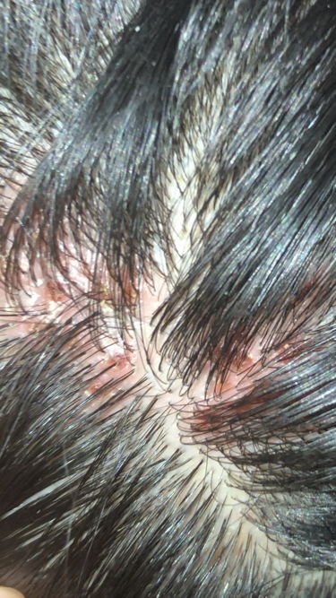 头皮有一块一按就痛