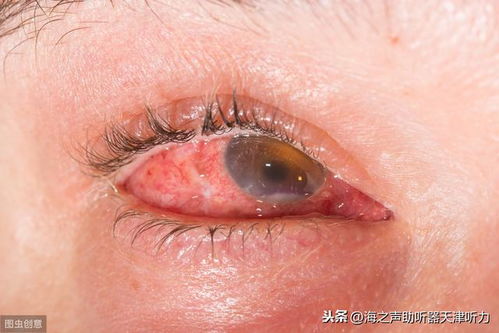 眼睛上火了肿了怎么办