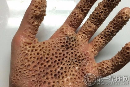 人类为什么会有密集恐惧症?