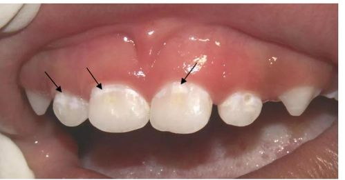 宝宝牙齿脱矿早期图片,牙齿脱矿如何补救