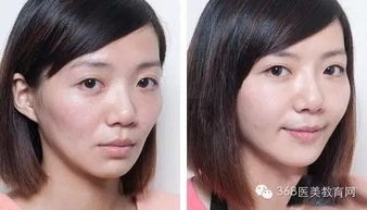 面部凹陷填充是永久的吗