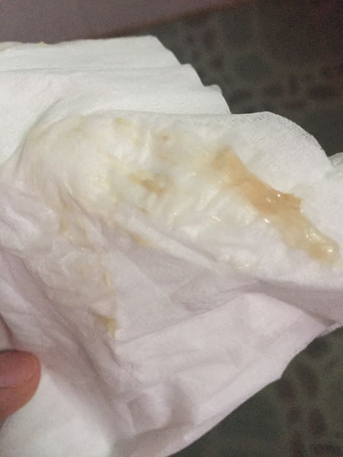 大便后有透明果冻状粘液,是什么状况