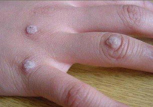 瘊子图片 求大神指教 在线等