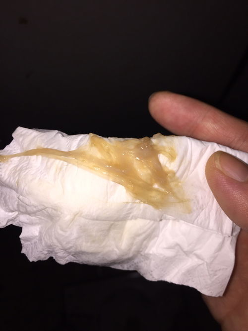 子宫底下降 在分娩前数周,因胎头入盆,孕妇会感觉上腹部轻松了一些