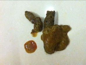 如果患者大便呈果酱样,就证明是上消化道出血,上消化道就是胃